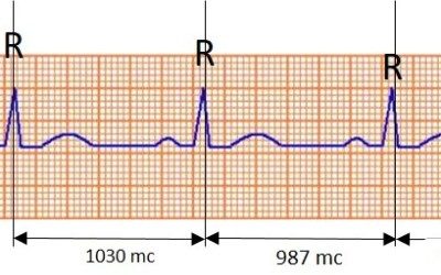 Co je to kardiogram a čím se liší od rytmogramu R-R