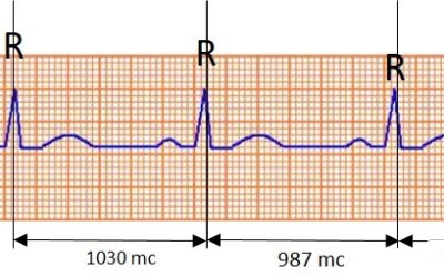 Co je to kardiogram a čím se liší od rytmogramu R-R